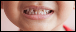 Baby Bottle Tooth Decay picture showing decay on a child's teeth